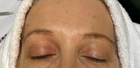 After 1 Hour Treatment