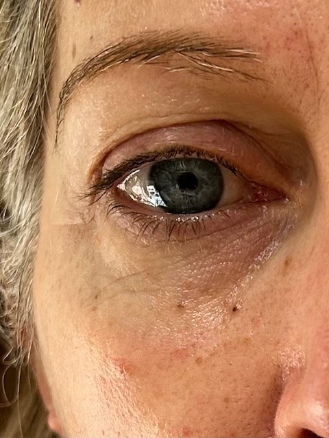 After 6 Weeks of Treatments